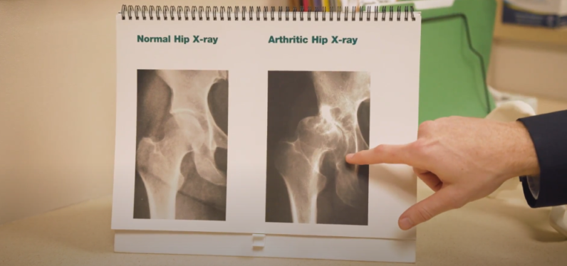Anterior vs. Posterior Total Hip Replacements