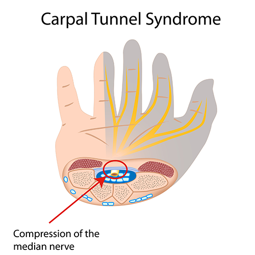 Hand and Wrist Injuries – Arthritis in Wrist Joint – Joint Pain