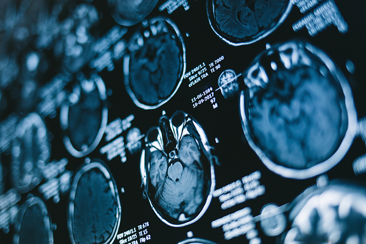 อะไร คือ Cerebrovascular Disease