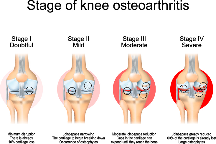 Meniscus Treatment Cream Knee Joint Arthritis Rheumatoid Pain